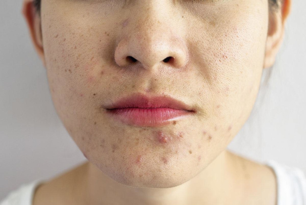 Acne in de kijker! 