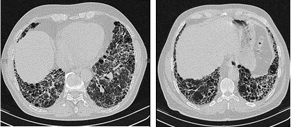 Maladies rares : la fibrose pulmonaire idiopathique et ses défis