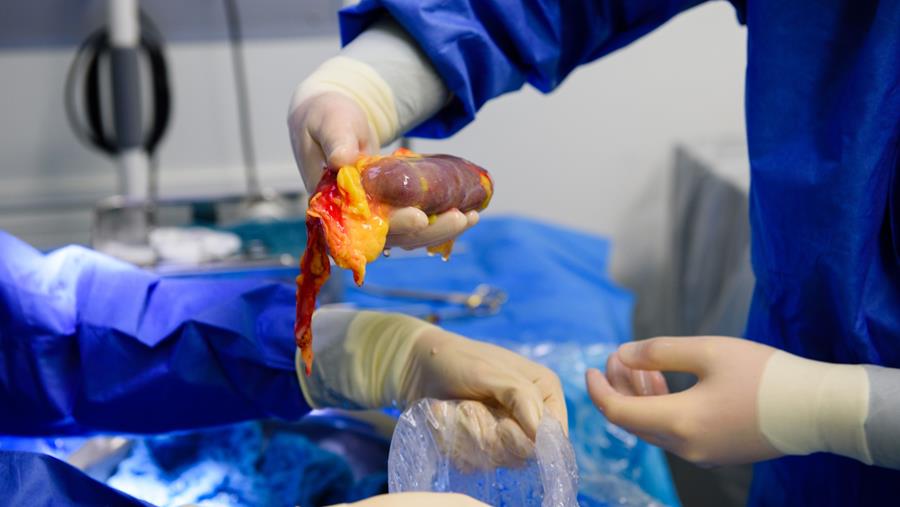 Un nouvel outil permet de mieux cartographier le rejet après une transplantation rénale